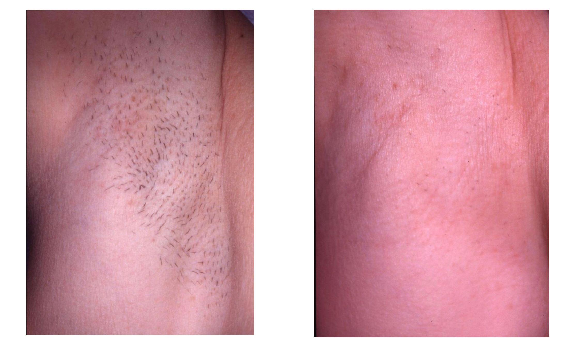 Hair removal Tangerang: Solusi Tepat Kulit Lebih Halus dan Terawat