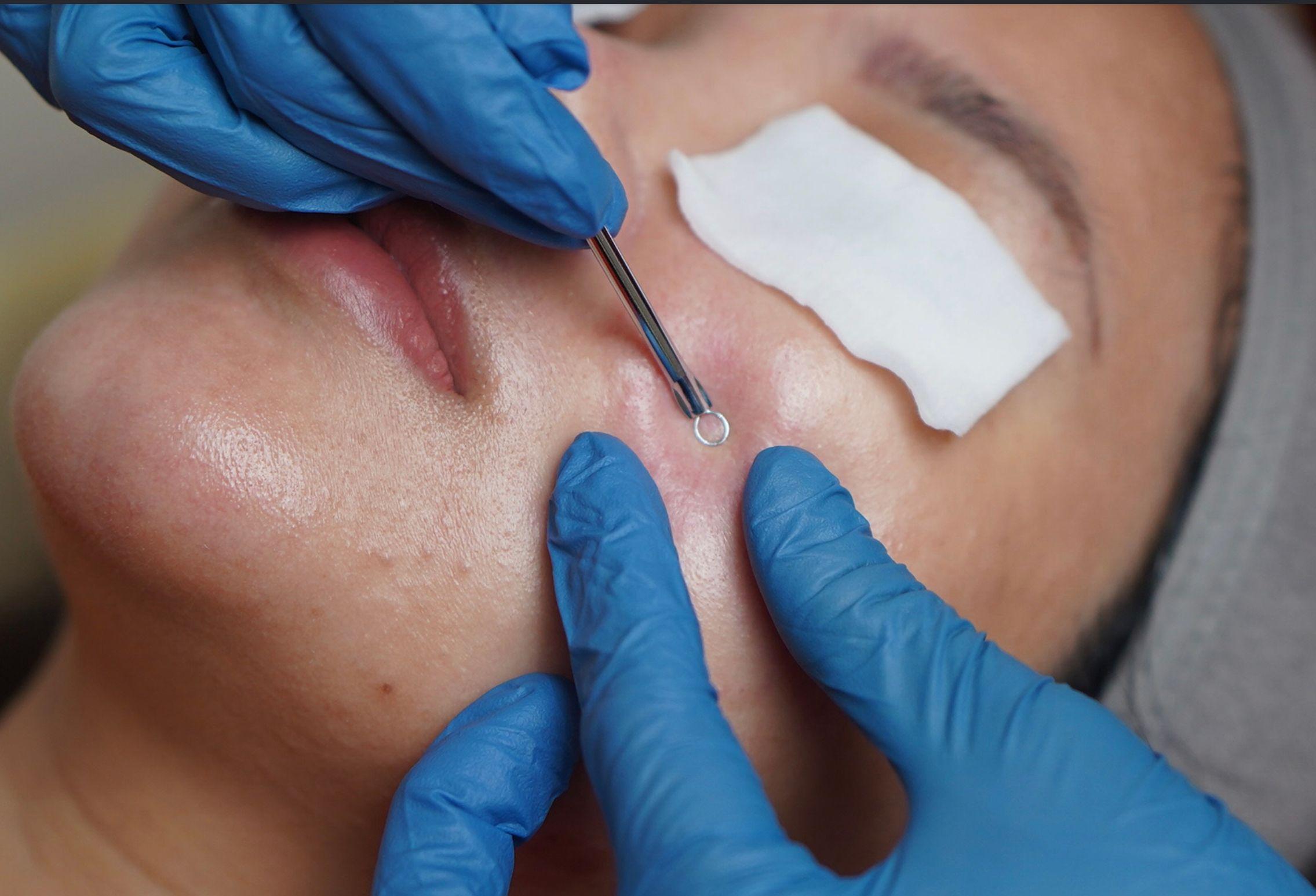 Facial Jerawat Tangerang: Solusi Tepat Menjaga Kulit Bersih dan Sehat