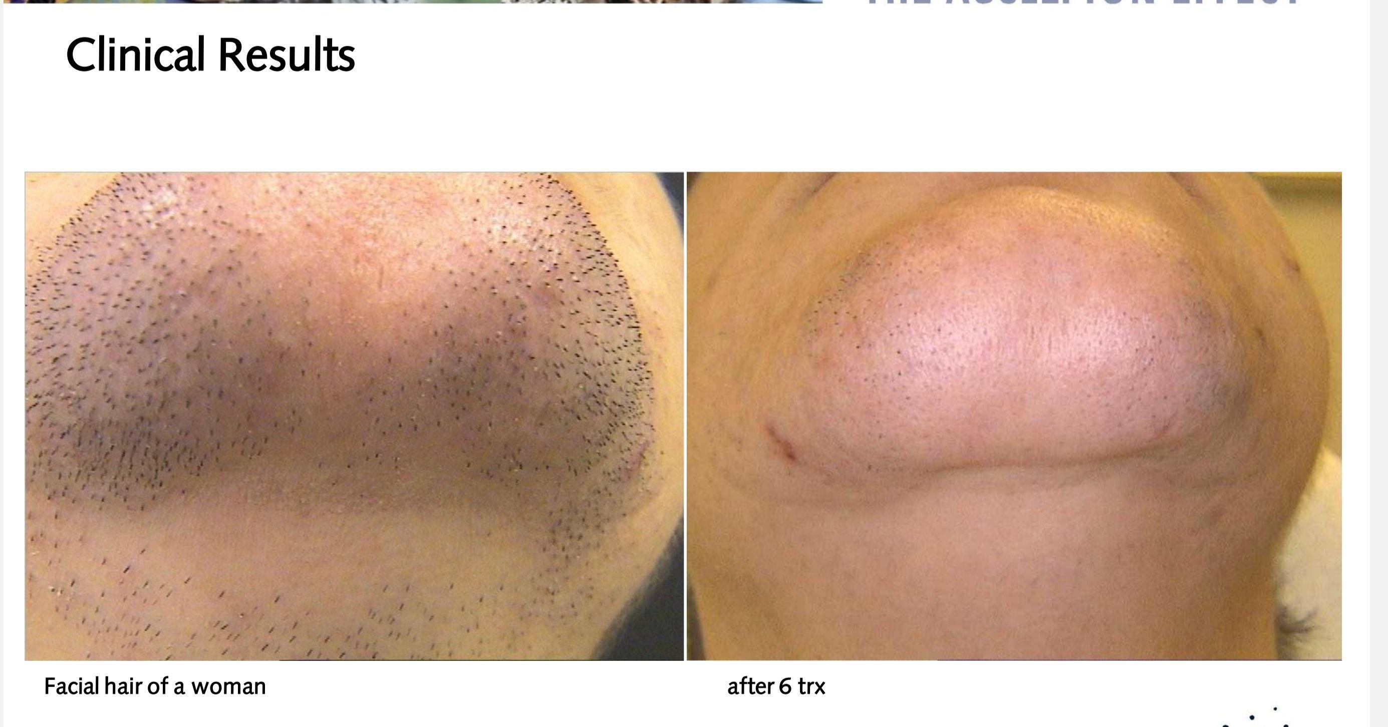 Sering Ingrown Hair Setelah Cukur?