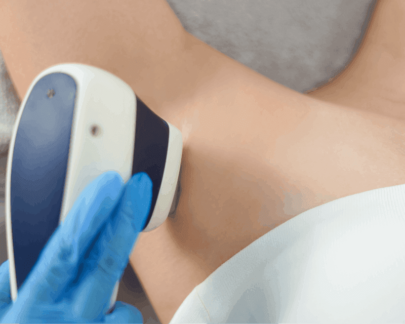 Hair Removal Laser