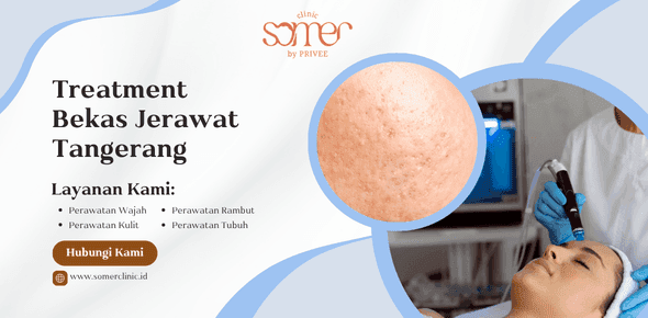 Treatment Bekas Jerawat Tangerang untuk Kulit Halus