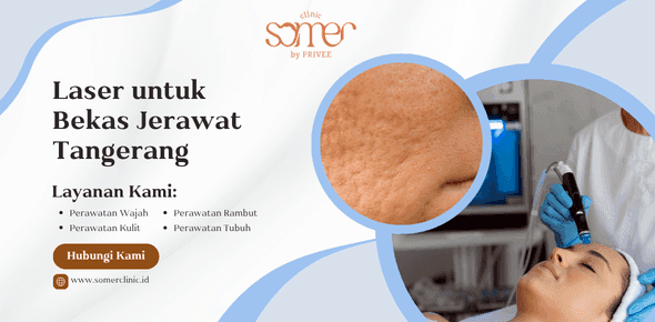 Laser untuk Bekas Jerawat Tangerang: Solusi Ampuh Wajah Halus Bebas Bopeng