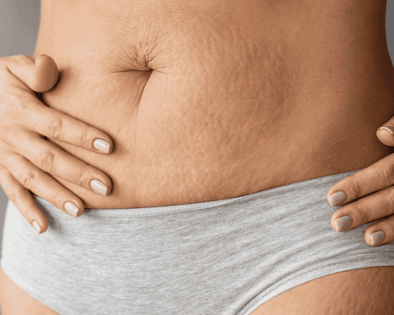 Stretchmark