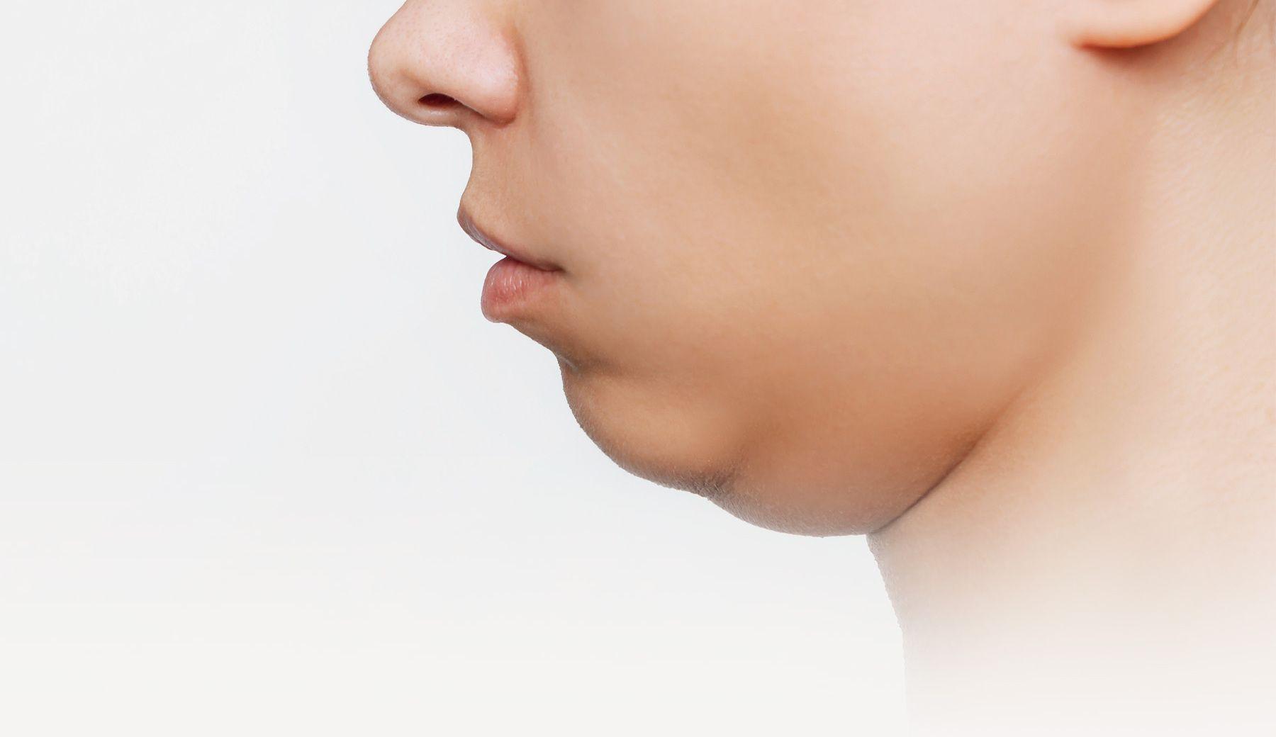 Double Chin Bukan Selalu Karena Gemuk : Ini Penyebabnya