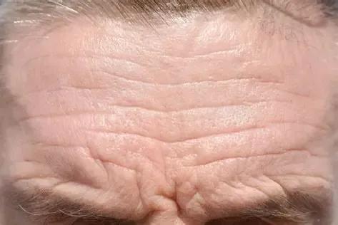 Botox Tidak Mempan? Belum Tentu Resisten