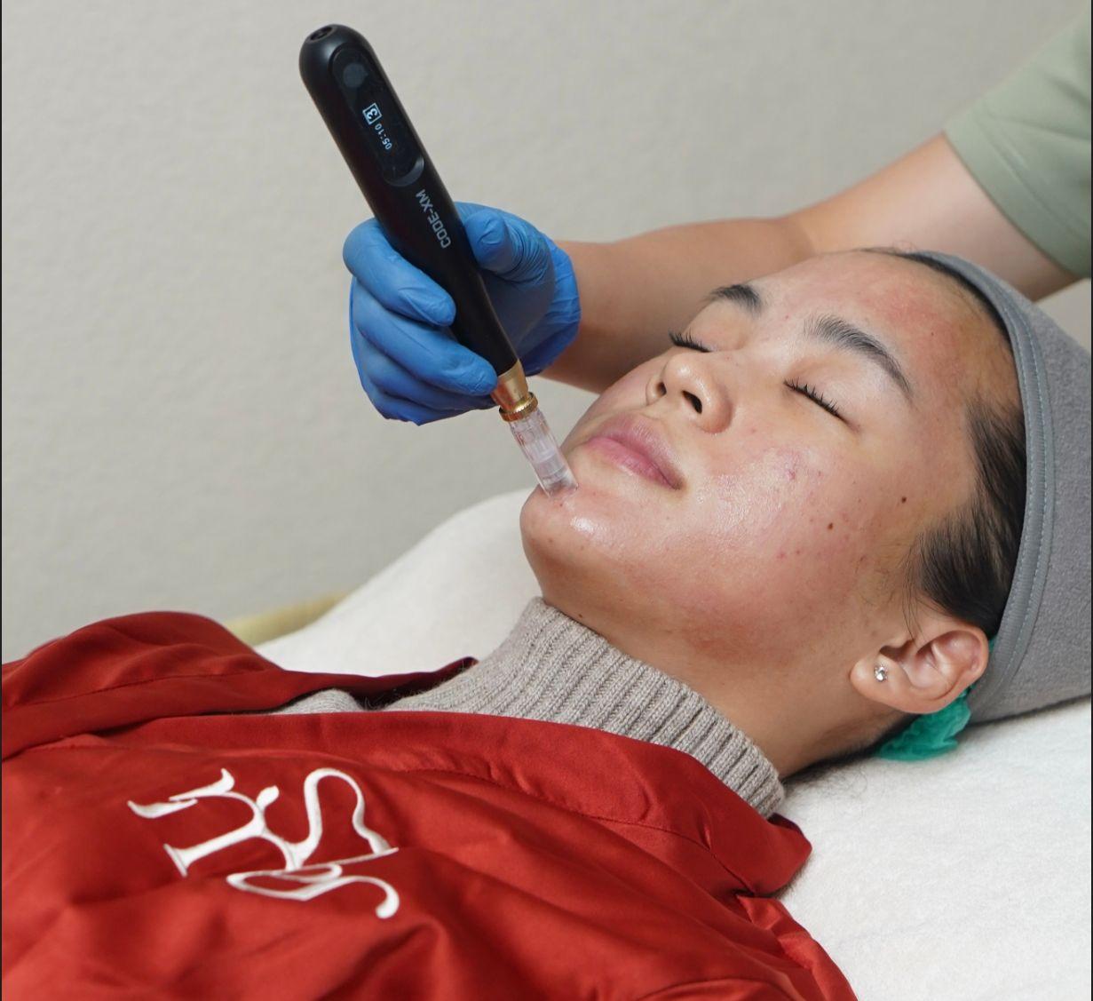 Microneedling Exxo