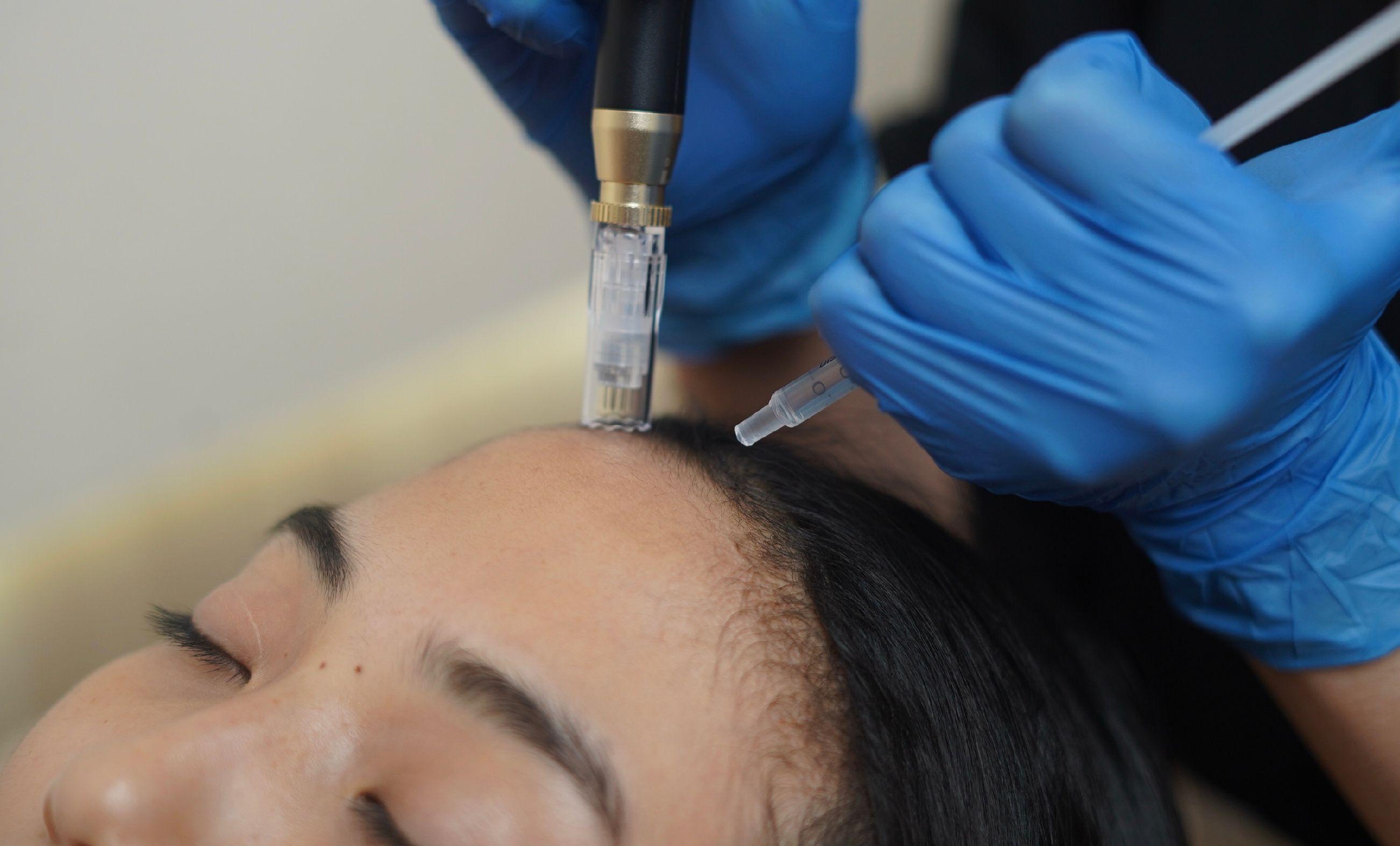 Microneedling Hair