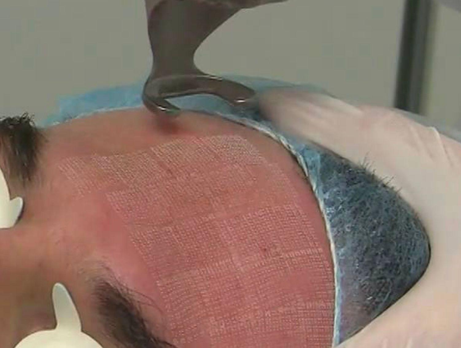 Scar Fractional Laser