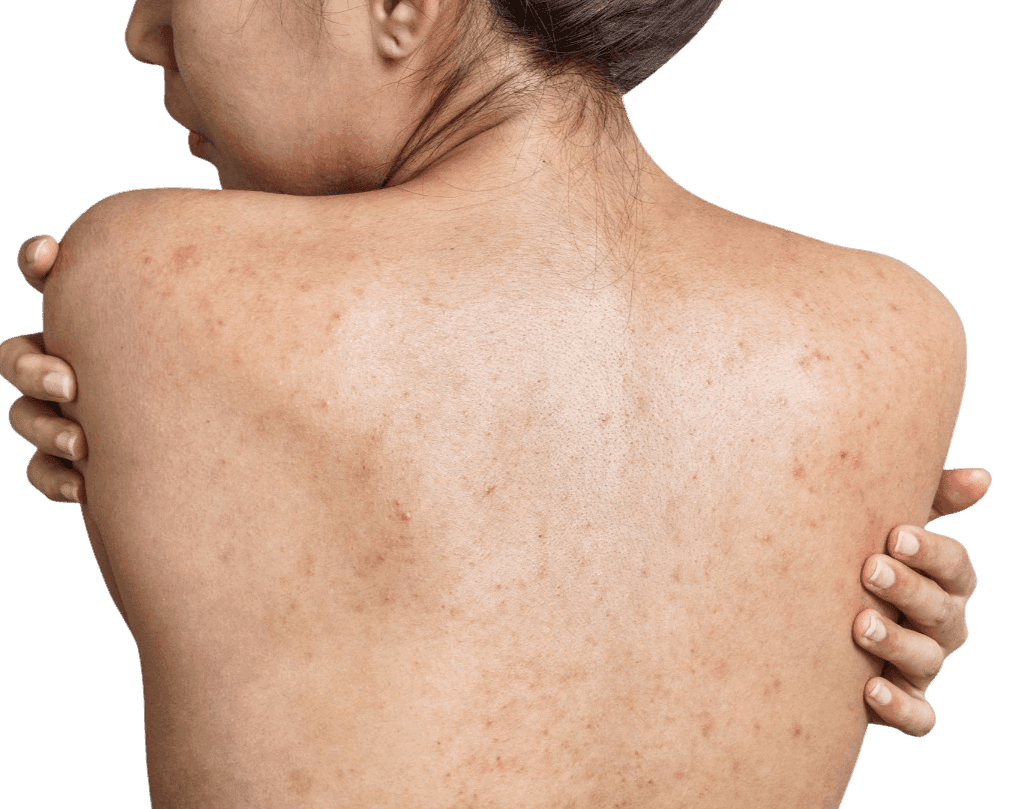 Body Peeling