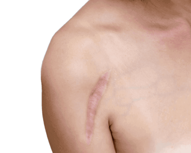 Keloid or Scar